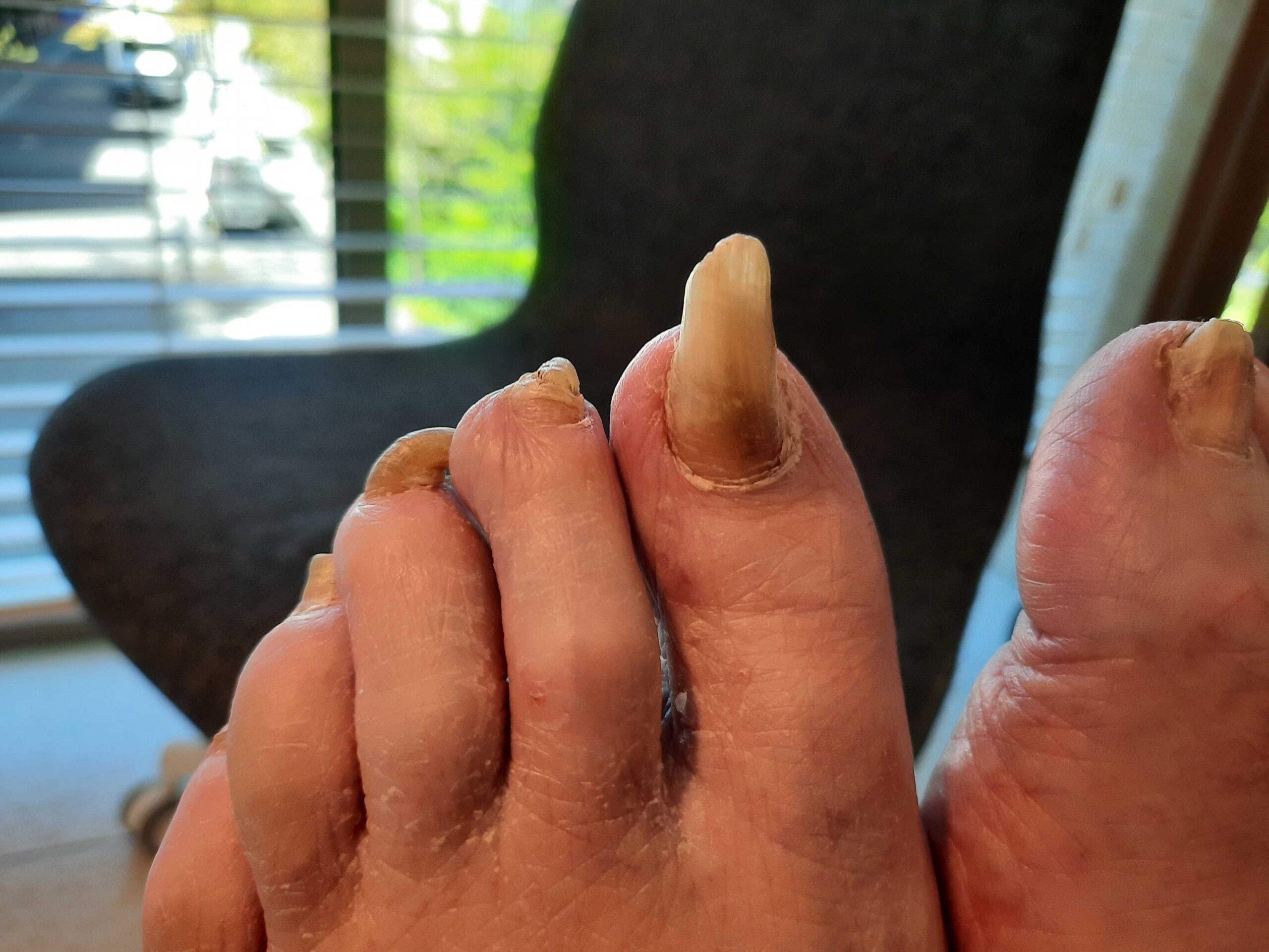 Dystrophic nails before treatment