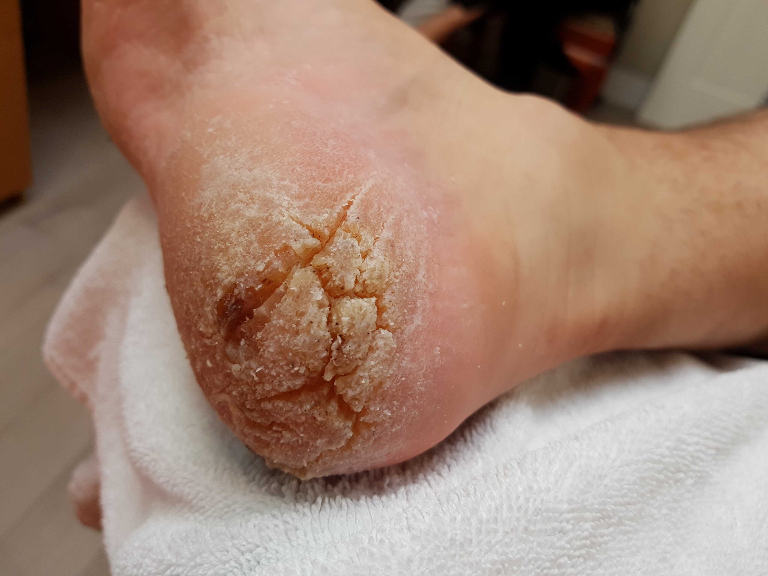 Fissures before treatment