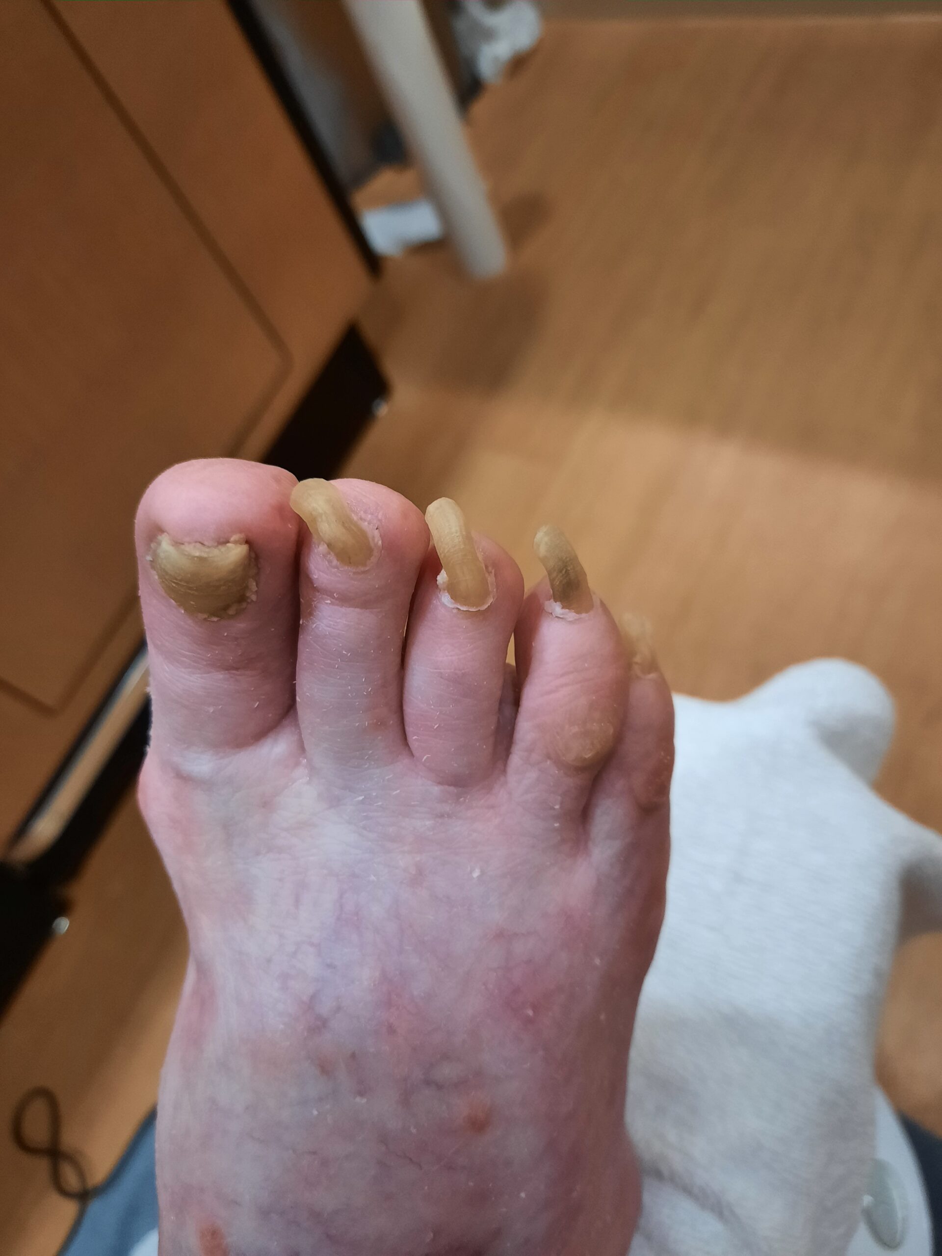 Onychomycosis nails before debridement