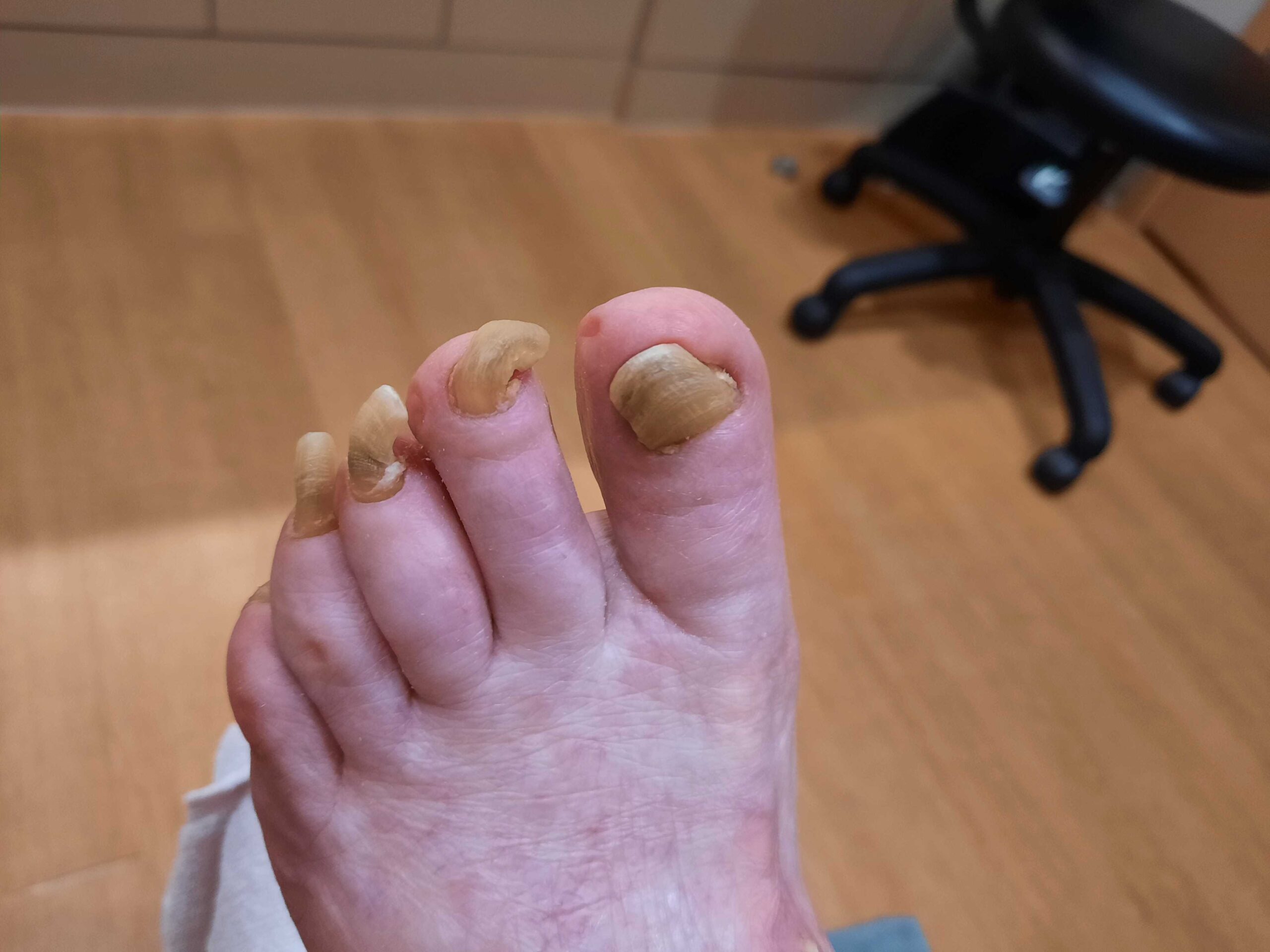 Ramshorn nails before