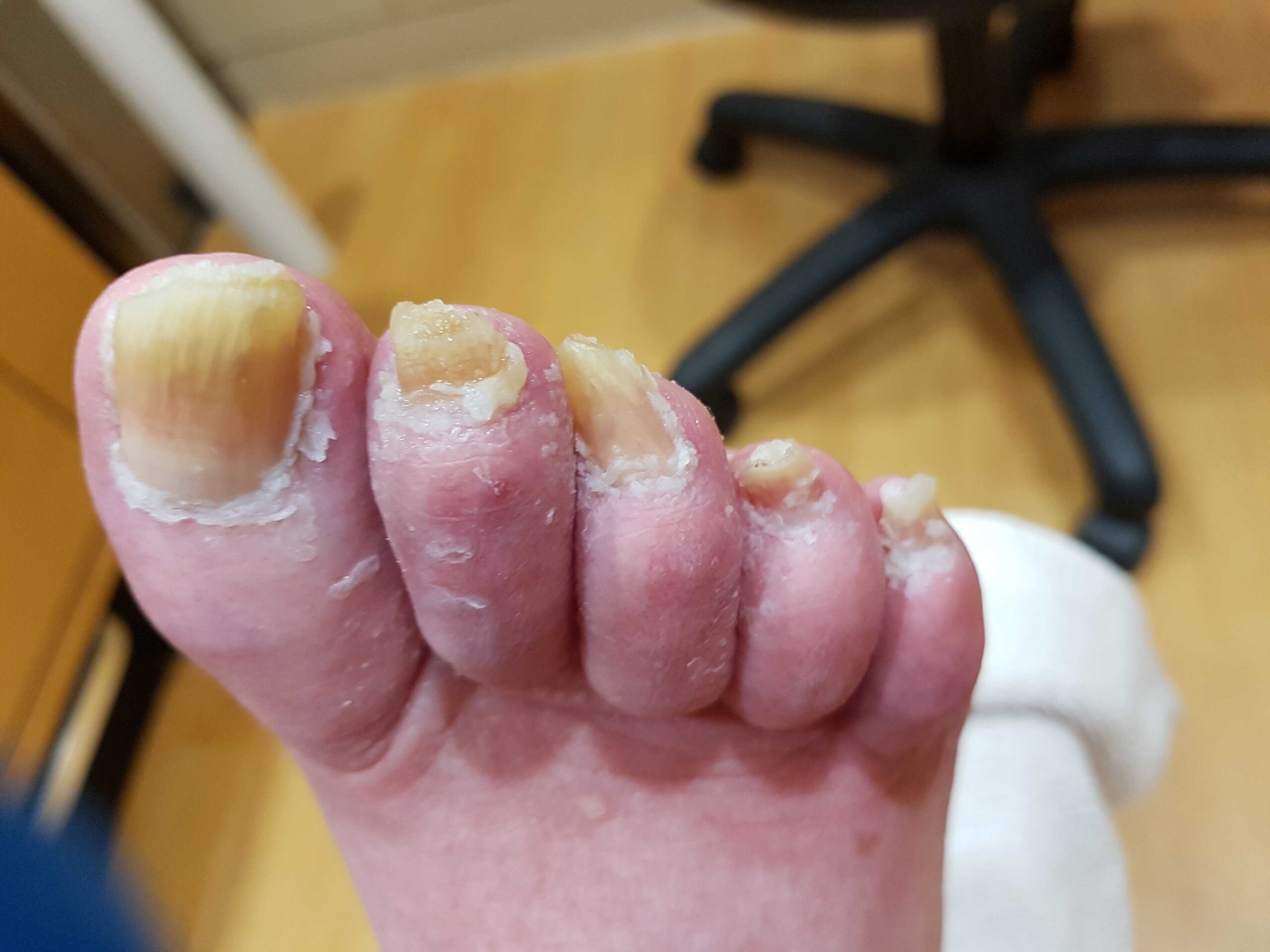 Regular Treatment Before